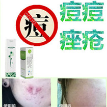 Acne marks acne scars back repair solution chest bean removal acne marks and acne products for men and women