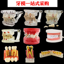 Oral standard dental model implantation detachable nerve dental model restoration full mouth pathology doctor-patient communication model