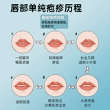 Акловирский мазированный гель подлинный подлинный молоко, окрашенное в Аноров, простые герпесные трещины угла рта, язвы, герпеса, осадки, огня, пенообразования специальных язв, герпес, генитальных герпес, герпес, герпес, герпес, герпес, герпес, герпес, герпес, герпес, герпес, герпес, герпес