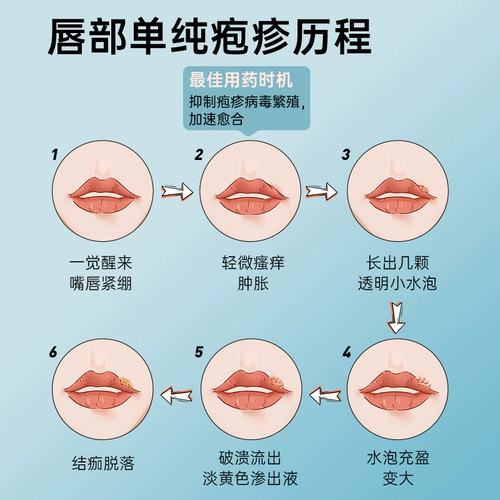 Акловирский мазированный гель подлинный подлинный молоко, окрашенное в Аноров, простые герпесные трещины угла рта, язвы, герпеса, осадки, огня, пенообразования специальных язв, герпес, генитальных герпес, герпес, герпес, герпес, герпес, герпес, герпес, герпес, герпес, герпес, герпес, герпес