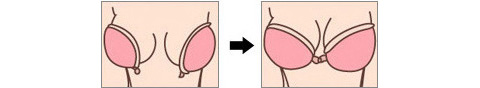 Silicone vô hình áo ngực dán đồ bơi bikini cô dâu váy cưới không có ngực ngực ngực nhỏ tập hợp dày quần xì áo vú