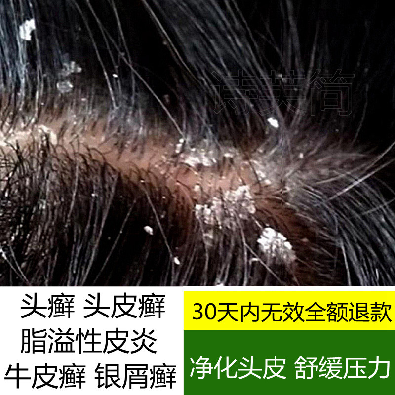 头皮癣怎么治,头癣,结痂_大山谷图库