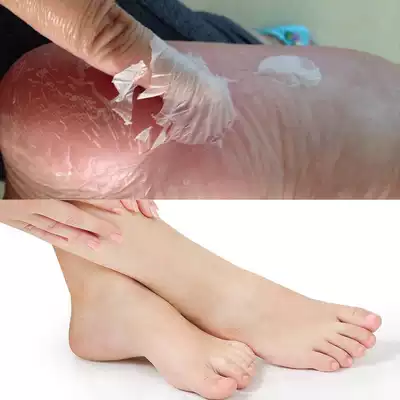 拍2发6 脚膜去死皮老茧足膜脚后跟干裂脱皮嫩脚神器足部护理足贴