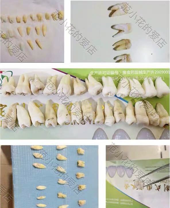Ex Vivo Teeth, Real Human Teeth, Pulp Exposure, Root Canal Treatment, Exam-Specific, Complete, Undamaged, No Caries, Skill Operation