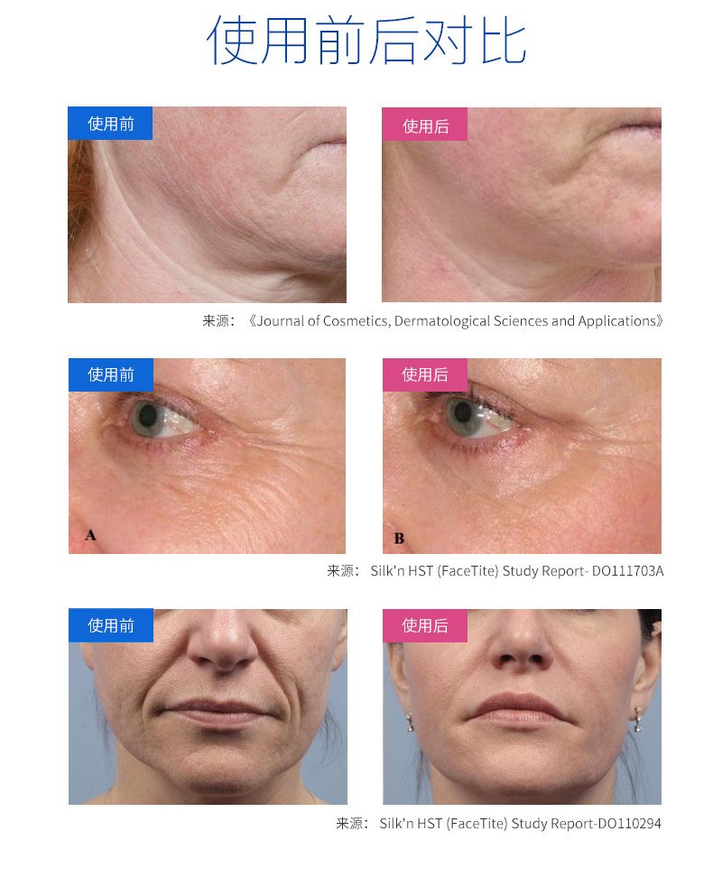 Silk'n Face Tite三源射频美容仪 ￥912 含130ml按摩凝胶 中亚Prime会员免运费直邮到手约￥1000 天猫￥2199