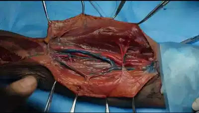 Orthopedic skin flap microsurgery hand surgery automatic delivery