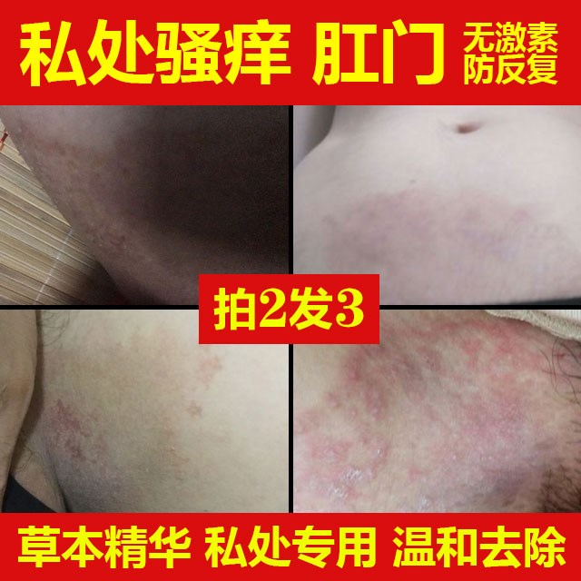 坐瘡膏臀部背部痘痘癢屁股褥瘡膏大腿內側瘙癢紅斑紅疹過敏止癢膏