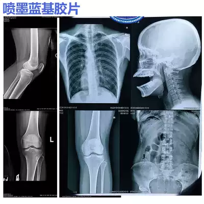 Hospital inkjet printing Blue-based radiation negatives DR CR CT X-ray MR magnetic resonance inkjet blue film color composition