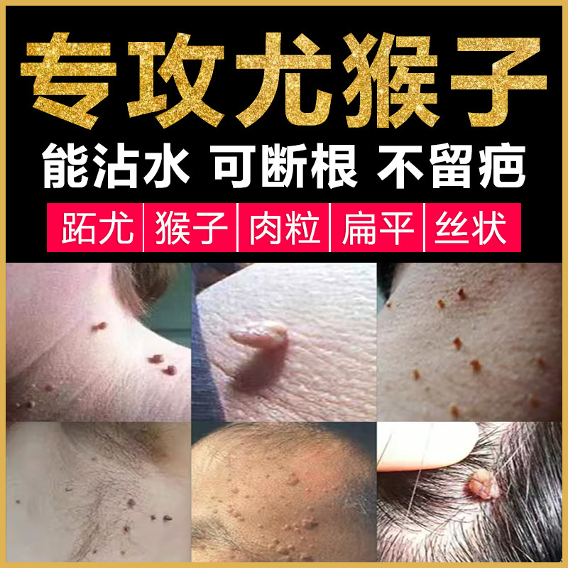 脖子上的烦恼?药刺猴子去除神器,告别皮赘丝状跖疣不再难!-浴足剂-淘宝好物网