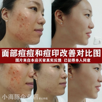 Red Blue Laser Acne Acne Face Acne Pit Household Beauty Software Textile Acne