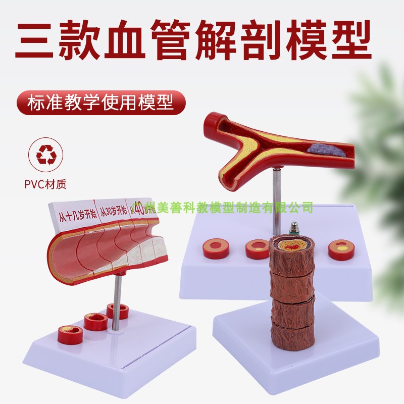 血管/堵塞动支脉粥样/硬化心血管动脉/ 硬化模型血管病理模型血栓