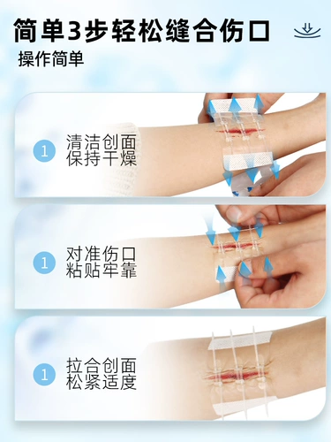 Тензор кожи шрам, свободный от шить