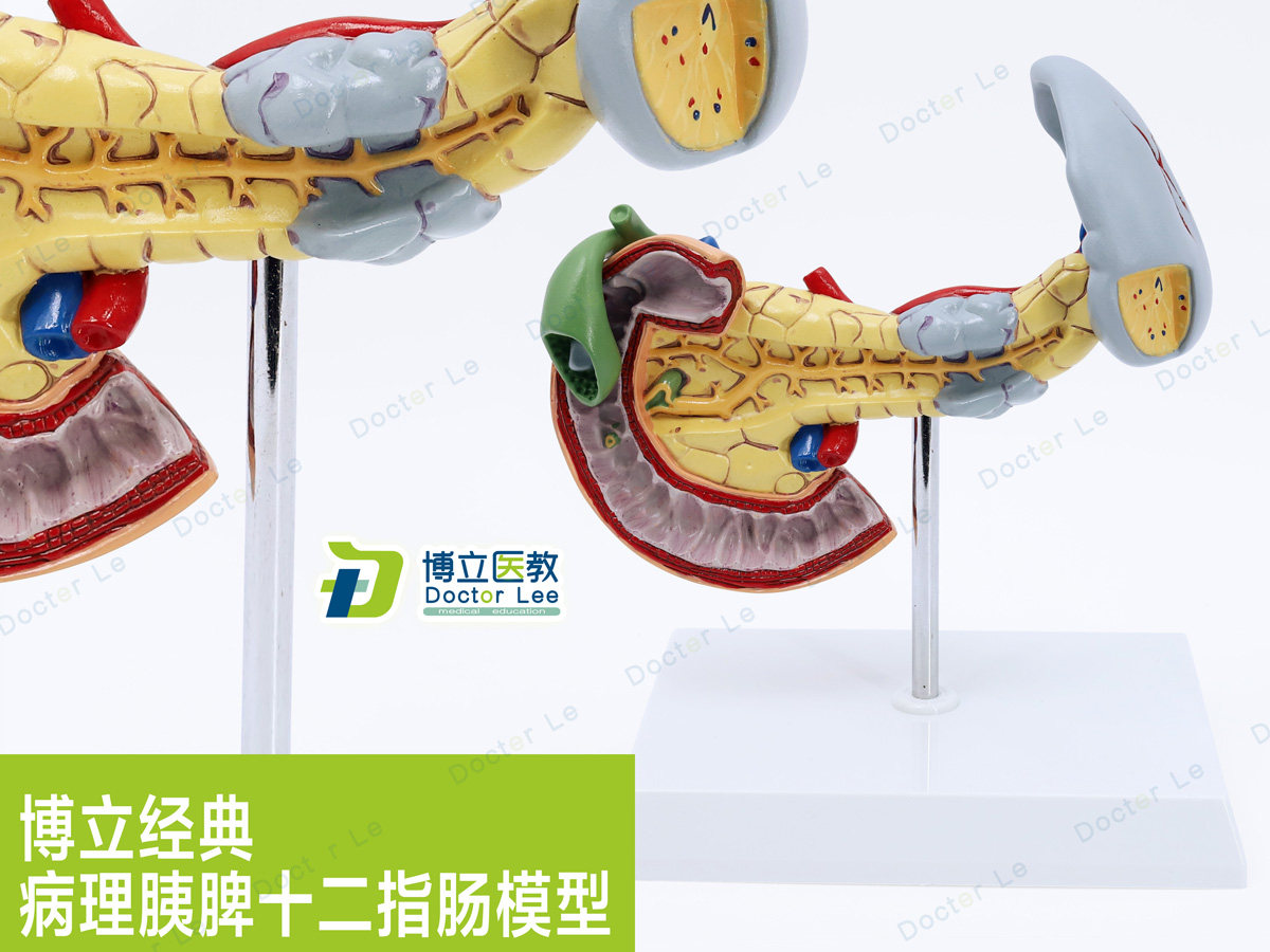 消化胰脏病变胰脾胆十二指肠模型进口模型 人体病变内脏解剖模型