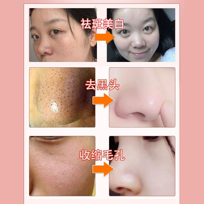 30 lá lúa gạo hydrating bó mụn trứng cá in mật khẩu nam và nữ để mụn đầu đen mùa đông mặt nạ se khít lỗ chân lông