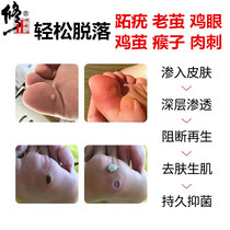 Plantar wart ointment Corns stick Foot virus artifact Common wart Toe wart Tang Lijing Meat thorn Non-Japanese removal of wart spirit