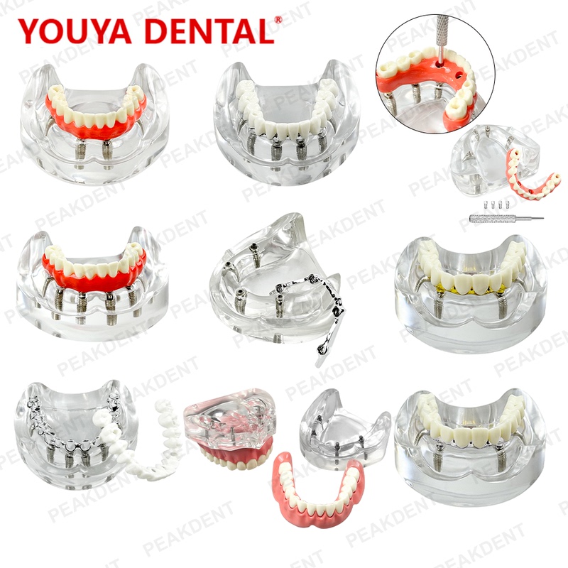 Oral Implant Model Dental Model Malong Partial Denture Restoration High-End Detachable Implant Dental Model Oral Implant Model Dental Model Malong Partial Denture Restoration High-End Detachable Implant Dental Model