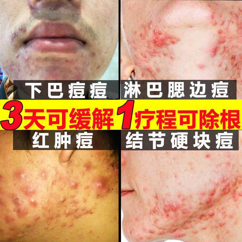 祛痘下巴淋巴腮边去脸颊两边腮帮子硬块痘结节性痘痘痤疮反复长痘