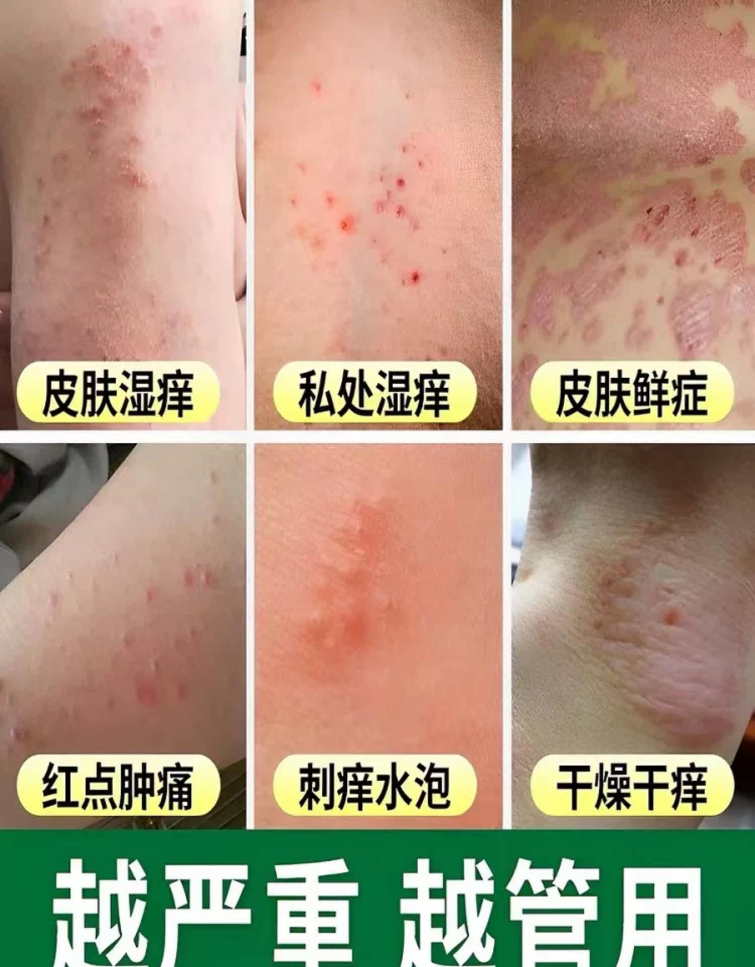 Антибактериальные карта 断痒杀毒膏头皮疙瘩背部痤疮痘痘全身皮肤瘙痒蚊虫叮咬消肿止痒膏