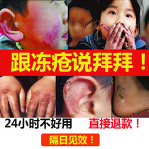 Frostbite cream for root swelling and itching Frostbite cream for children and adults Antifreeze cream for hands hands feet face ears anti-cracking cream