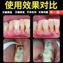 Tooth Loose Gingival Shrinking Regeneration Repair God Instrumental Ointment Solid Tooth Loose Tooth tooth Tooth Gingival Tooth Bleeding