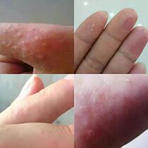 Shake-up. Recommended hands and feet peeling dry cracked coarse ultra-skin soles dry cracked skin and skin care hands and feet repair cream