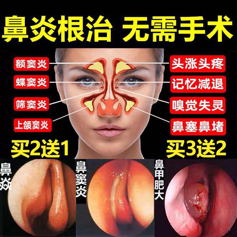 Goose does not eat grass rhinitis spray ointment to cure allergic rhinitis artifact sinusitis nasal congestion through nasal turbinate hypertrophy