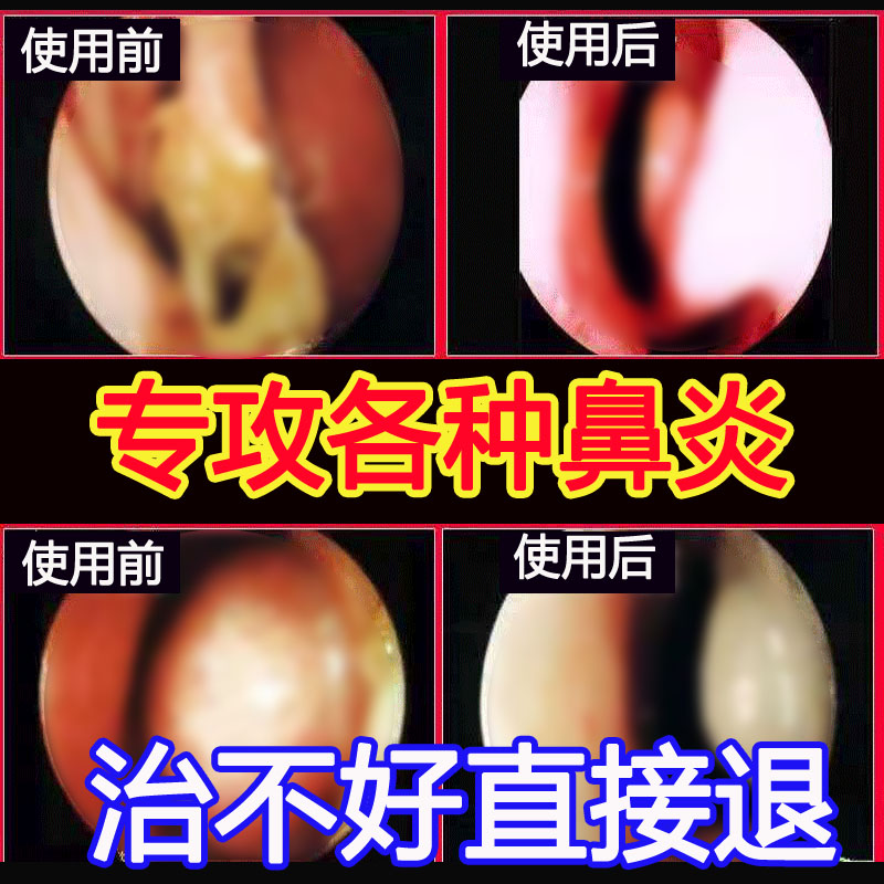 Bishutong rhinitis spray special effect medicine radical cure turbinate hypertrophy artifact allergy rhinitis ointment nasal congestion Japanese ventilation - Taobao