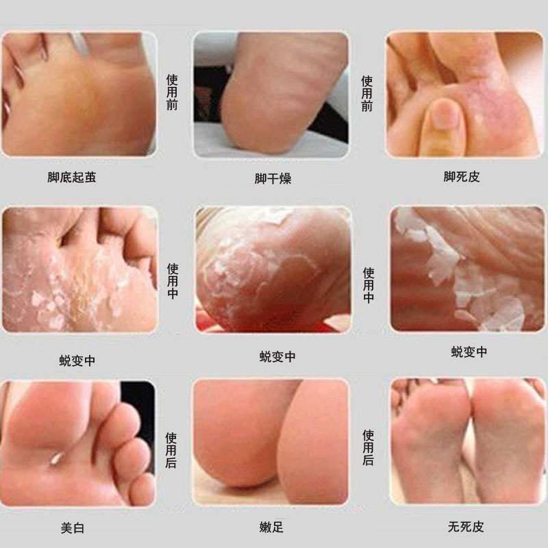 Bàn chân tẩy da chết tẩy tế bào chết để loại bỏ da chết kem trị nứt gót chân