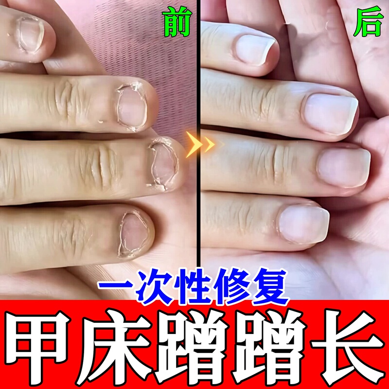 Nail Bed Repair Growth Solution for Damaged, Receding, and Separated Nails; Nail Care Oil for Growth Nail Bed Repair Growth Solution for Damaged, Receding, and Separated Nails; Nail Care Oil for Growth