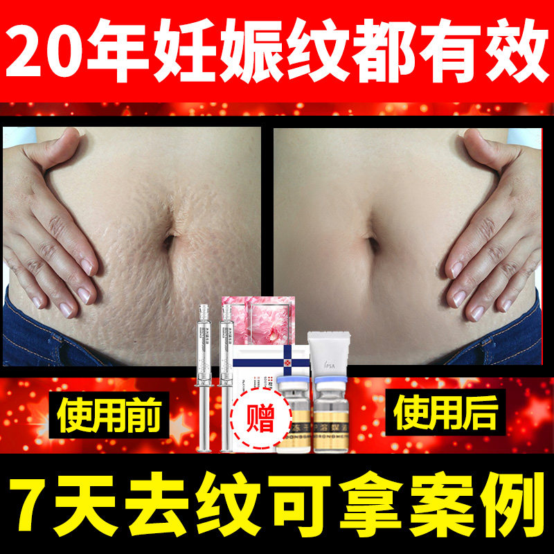 De-stretch mark micro-needle repair cream removes pregnancy wrinkles postpartum de-tightening removal instrument Do not wrinkle fat wrinkles fade
