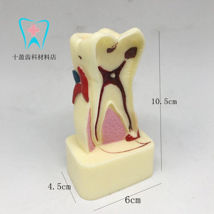 Dental oral teaching model 4 times dental syndrome model caries evolution model doctor-patient communication