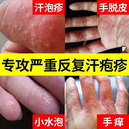 Поттцер, пот, герпес, мазь мазь, спор, споры пота, идите к руке, чтобы получить маленькие пропитанные водой руки, зудящая потная экзема, анти -сильная кожа корня