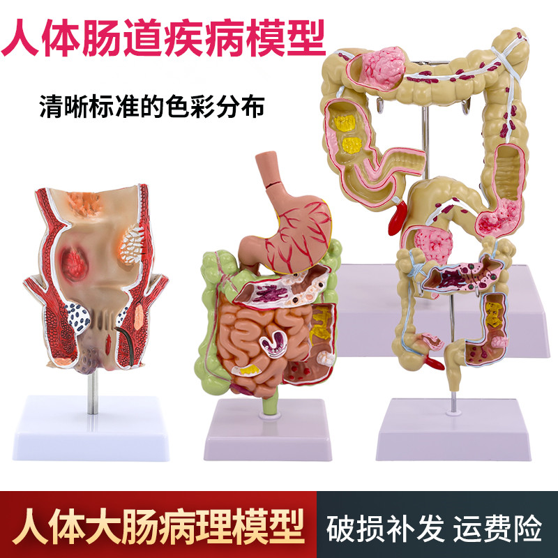大肠病理模型 结肠直肠 肠胃病变解剖 人体肠道疾病结肠病变模型