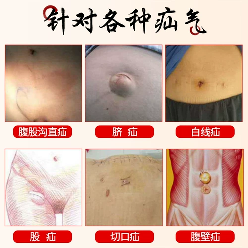 忆林 Hernia Stickers в пожилой пах, старая грыжа с пупочной грыжей, взрослый ребенок -ребенок выпуклый пупок