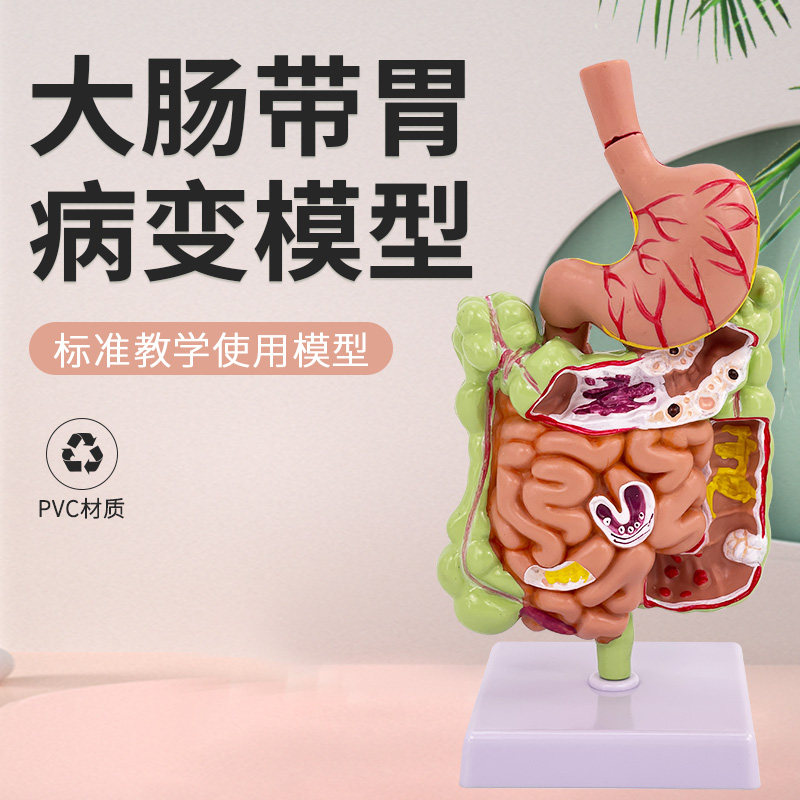 大肠病理模型 肠胃模型 大肠病变模型 肠道疾病 人体结肠病变模型
