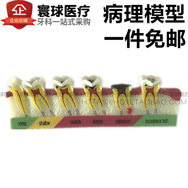 口腔讲解模型牙科讲解教学磨形龋齿病例进展模型医患沟通齿科材料