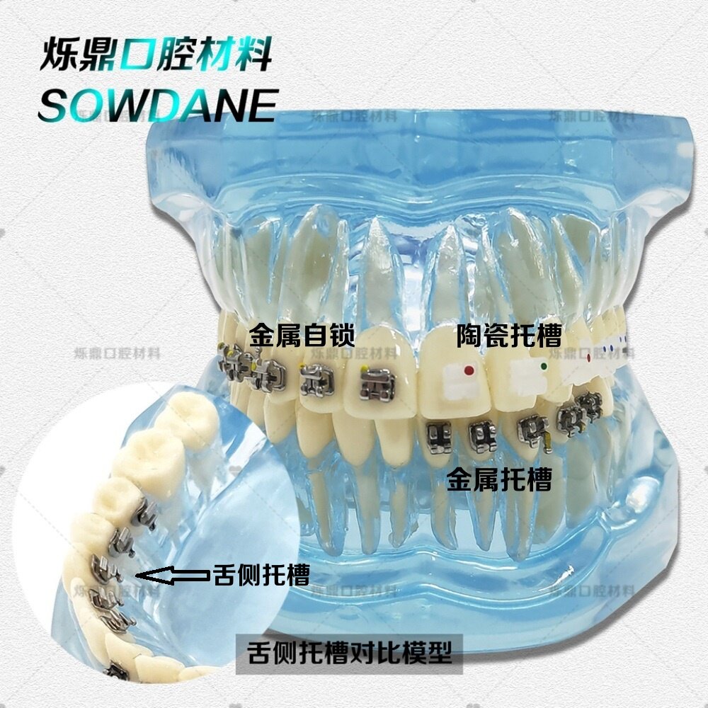牙科正畸牙模型金属自锁陶瓷托槽金属托槽舌侧托槽4对比模型教学