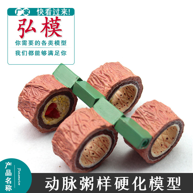 动脉粥样硬化模型 血栓病变过程模型 血管病理教学模型