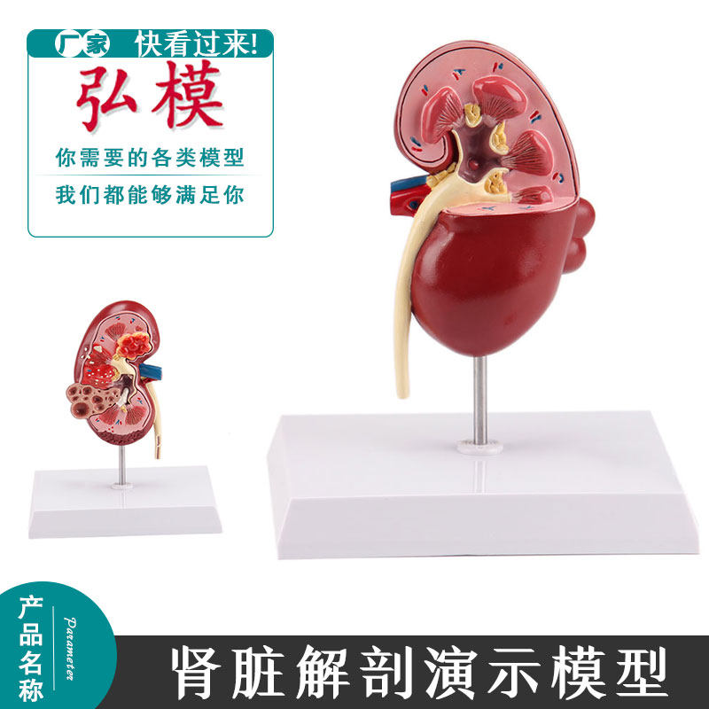 弘模人体肾脏病理模型 肾病变解剖 肾结石 泌尿科肾解剖模型 教具