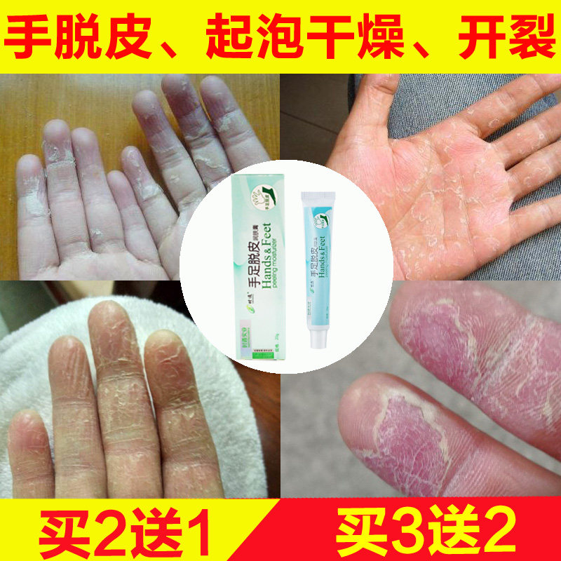 cream for peeling hands