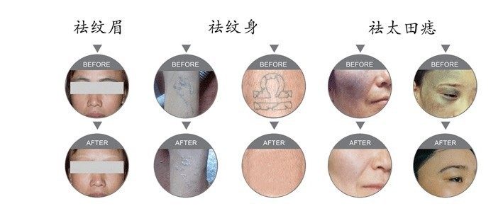 点击打开原图 OPT脱毛仪冰点无痛激光洗眉洗纹身多功能美容仪器