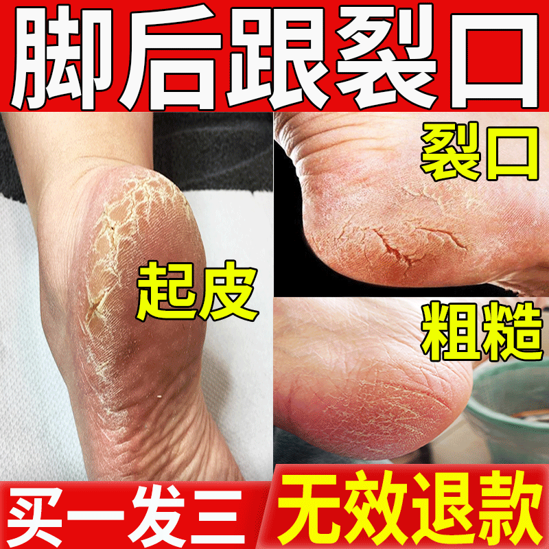 Heel sole heel skin dead skin peeling dry cracked dry Turtle cracked cream Cracked Skin Non repair cream not to go
