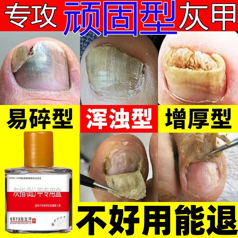 Thickening and Yellowing Toenails, a Magic Solution for Gray Nails, Medicine for Turning Thick, Yellow, and Hard Toenails into Healthy Nails Thickening and Yellowing Toenails, a Magic Solution for Gray Nails, Medicine for Turning Thick, Yellow, and Hard Toenails into Healthy Nails