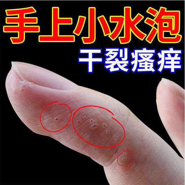 Small blistering hand blistering blistering blistering skin peeling dry hands cream to skin dry seasonal anti-repeated