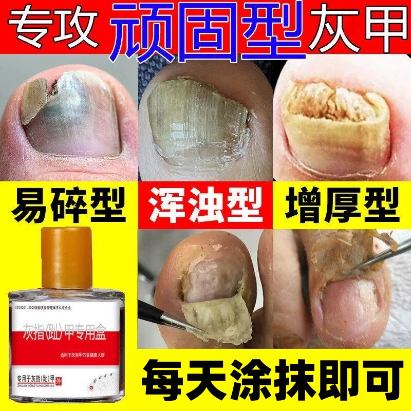 The Magic Solution for Thickened and Grayish-Yellow Toenails: Medicine for Turning Thick, Yellowed, and Hardened Toenails into Healthy Nails The Magic Solution for Thickened and Grayish-Yellow Toenails: Medicine for Turning Thick, Yellowed, and Hardened Toenails into Healthy Nails