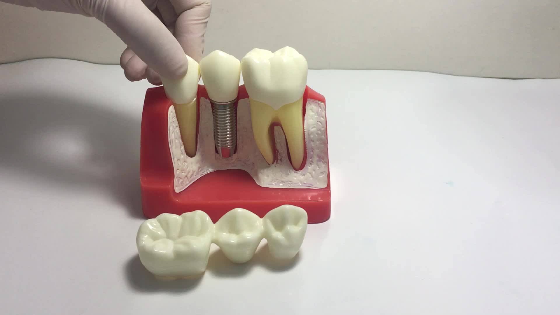 Расшифровка анализа крови на аллергены. Фиксатор челюсти в стоматологии. Одноэтапная методика имплантации. Анализы для имплантации зубов список. Список анализов перед имплантацией.