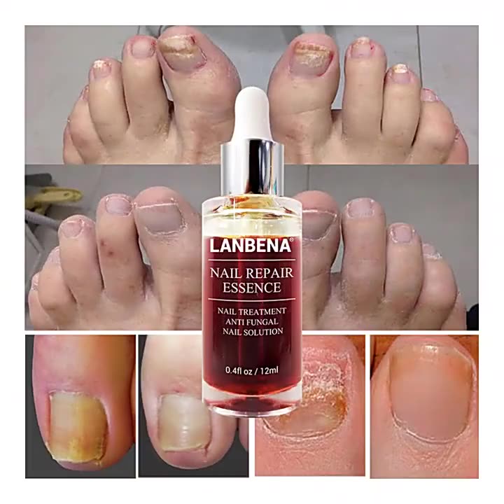 Naildoc RAPID Nagelpilz Behandlungs-Gel 5 Ml Günstig Kaufen