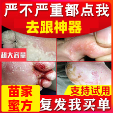 Другие средства реабилитации 狼毒根治脚气药止痒真菌感染水泡脚痒脱皮烂脚丫杀菌喷剂脚癣去根