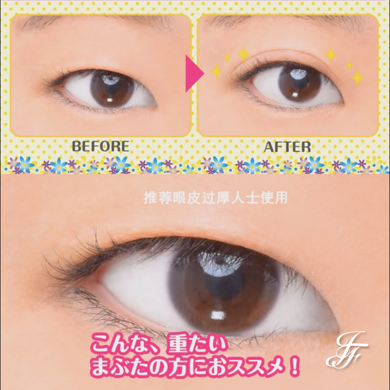 thick double eyelid