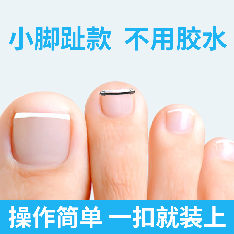 Little Toe Nail Corrector, Ingrown Toenail Corrector, Nail Inflammation Correction Device, Special Nail Inflammation Correction Patch
